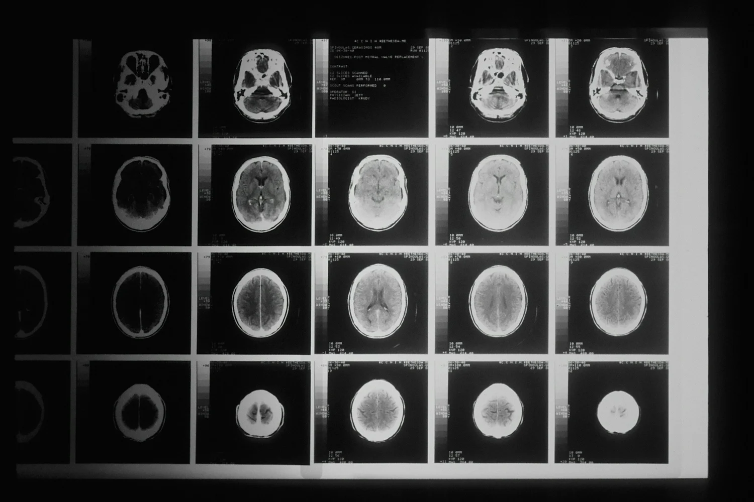 everyday-risks-leading-to-brain-injuries-in-florida-yxz4d Everyday Risks Leading to Brain Injuries in Florida | yourlawyeralex.com